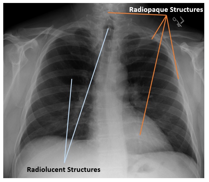 From XRay Beam to Image Signal Digital Radiographic Exposure