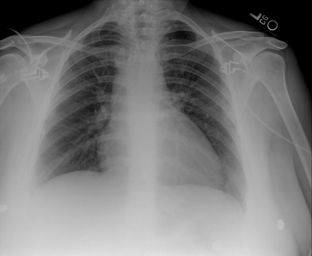 Case Analysis 4: Mrs. Spurlock’s Shoulder Pain – Evidence-Based ...