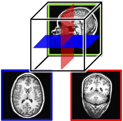 Figure 3. MRI slices of the human brain. Both the outer gray matter and inner white matter are visible in each image. The brain is a three-dimensional (3-D) structure, but an image is two-dimensional (2-D). Here, we show example slices of the three possible 2-D cuts through the brain: a saggital slice (top image), a horizontal slice (bottom left), which is also know as a transverse or axial slice, and a coronal slice (bottom right). The bottom two images are color coded to match the illustration of the relative orientations of the three slices in the top image.